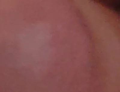 Immense Phimosis Being Extracted Cum and Précum.