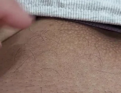 The Hair on My Penis - Led Hair Removal