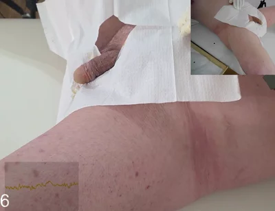 16 French Foley Insertion