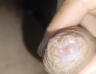 I Have the Largest Ejaculating Phimosis in the World!!