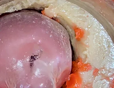 The Camera 4K Inside the Deep Pussy Records a Huge Ejaculation with a Stuck Condom