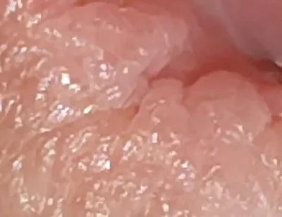 Enlargement of the Deep Urethral Hole!!