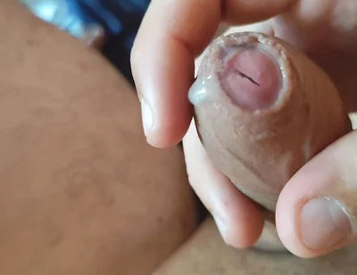 Dilation of the Corpus Cavernosum Exposes Spongy Foreskin.