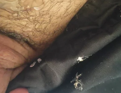 Uncircumcised Phimosis Has the First Ejaculation.
