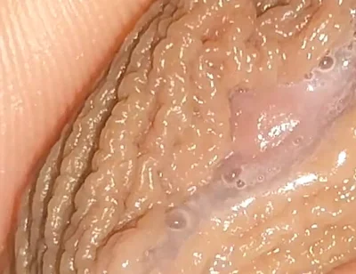 Curious Close-up of Pre-cum in Flaccid Phimosis.