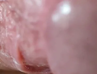 Opening the Scar of the Rough Frenulum!