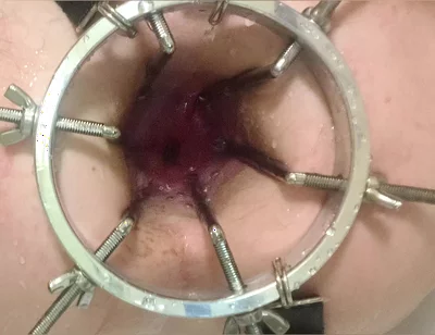 Enema, Anal Shower. Close-up View Through Anal Mirror. Anal with Water. Filling Anal with Water