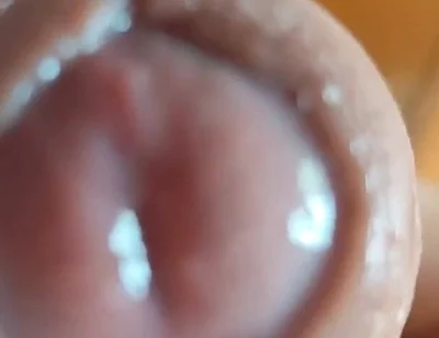 The Glans Appears Crowning Inside the Phimosis.