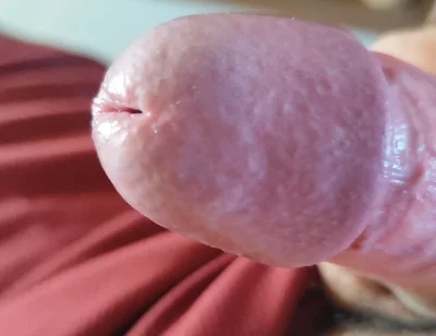 The Blossoming of Extensive Elastic Phimosis.