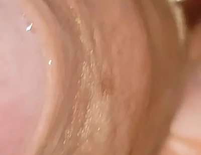 Large Cheese Accumulated in Close up of Glans