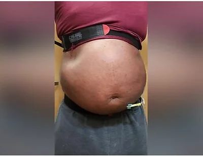 N2o Belly Inflation