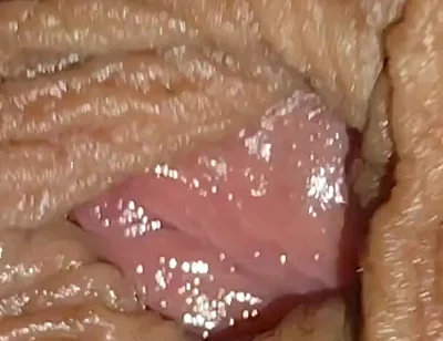 Boy with Large Anal Phimosis Excited!