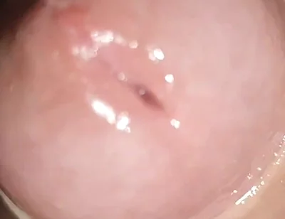 Maximum Dilation of Phimosis Cumming.