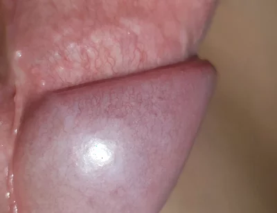 Amazing Upright Rough Venous Frenulum