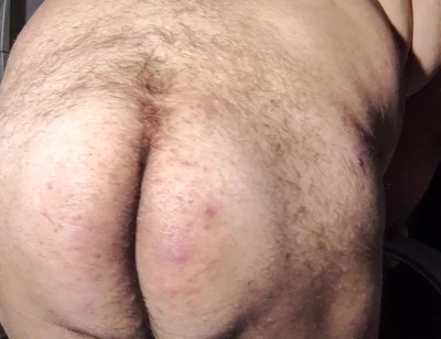 Fat Obese Butt