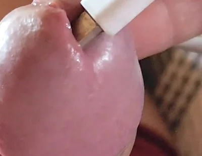 Applying Electric Shocks Inside the Glans.