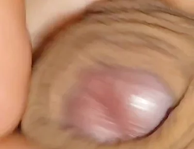 The World's Largest Foreskin Opening and Closing.