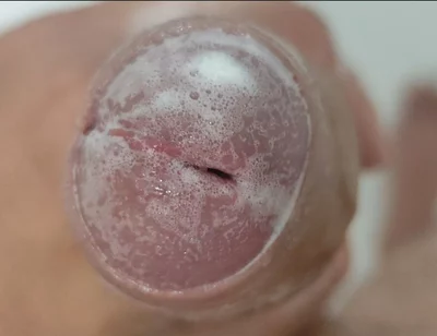 Extreme Burning Sensation Makes the Glans Foam with Arousal.