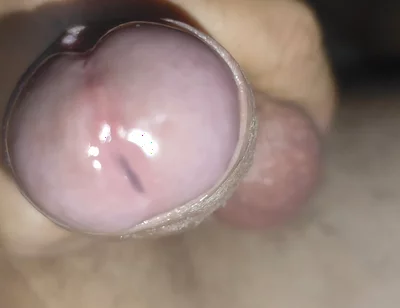 Scrotal Phimosis Results in an Extremely Hot Orgasm.