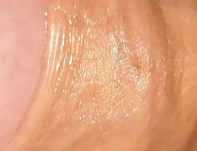 Difficult Fluid Control Due to Straight Phimosis.